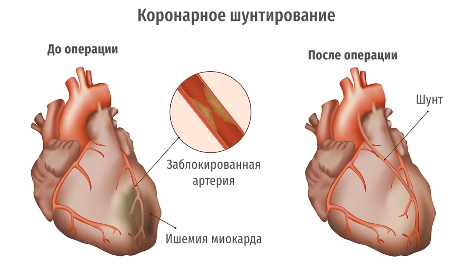 Шунтирование сердце простыми словами операция что такое. Шунтирование коронарных артерий сердца. Аортокоронарное шунтирование картинки.