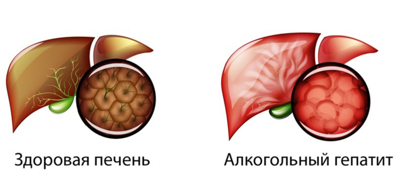 Какой гепатит алкогольный. Хронический алкогольный гепатит. Здоровая печень и гепатит. Алкогольный гепатит печени.