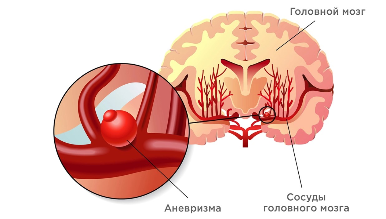 Аневризма головного мозга: причины, симптомы, диагностика и лечение