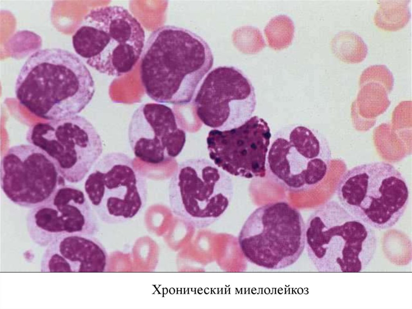 Лейкозы миелолейкоз. Хронический миелопролиферативный лейкоз. Миелолейкоз картина крови. Острый миелоидный лейкоз картина крови.